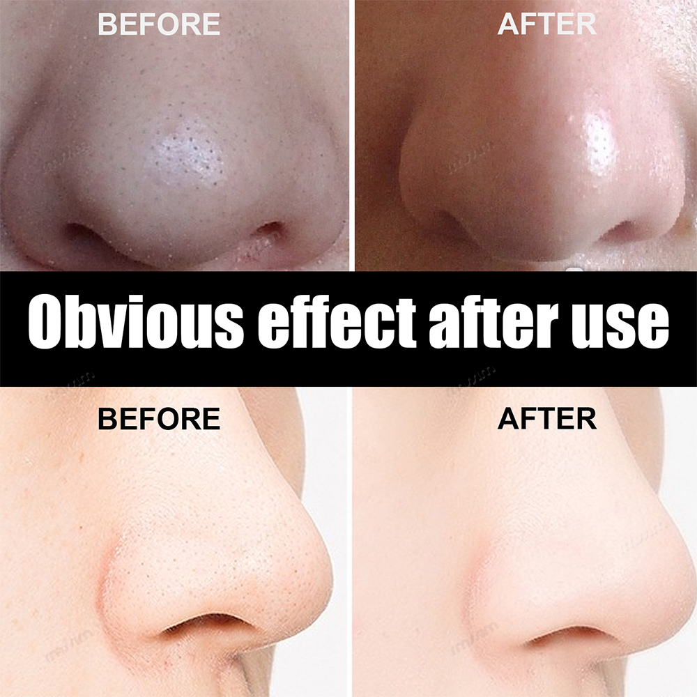 New 10-100pcs Unisex Blackhead - Skincare Indonesia reseña y precio